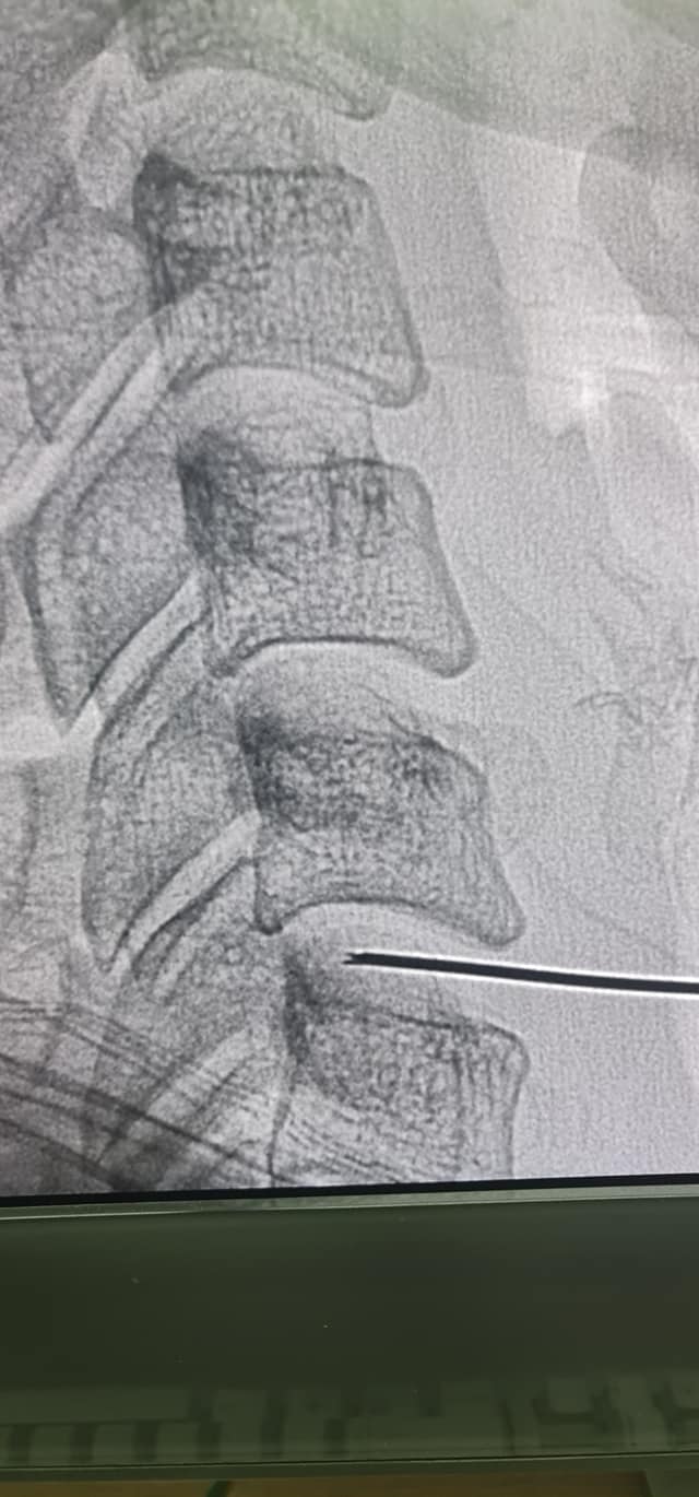 Percutenous Laser Disc Decompression Minimally Invasive Prosedure With 