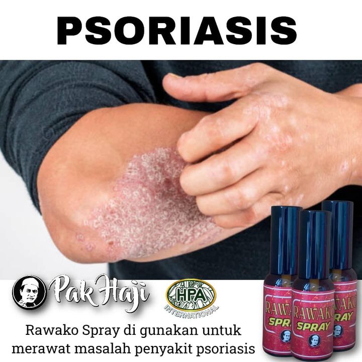 Rawako Spray Untuk Membantu Legakan Psoriasis 