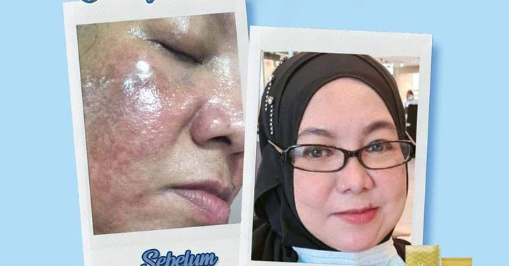 Akibat Tersalah Pakai Produk Yang Mengandungi Bahan Kimia,, 