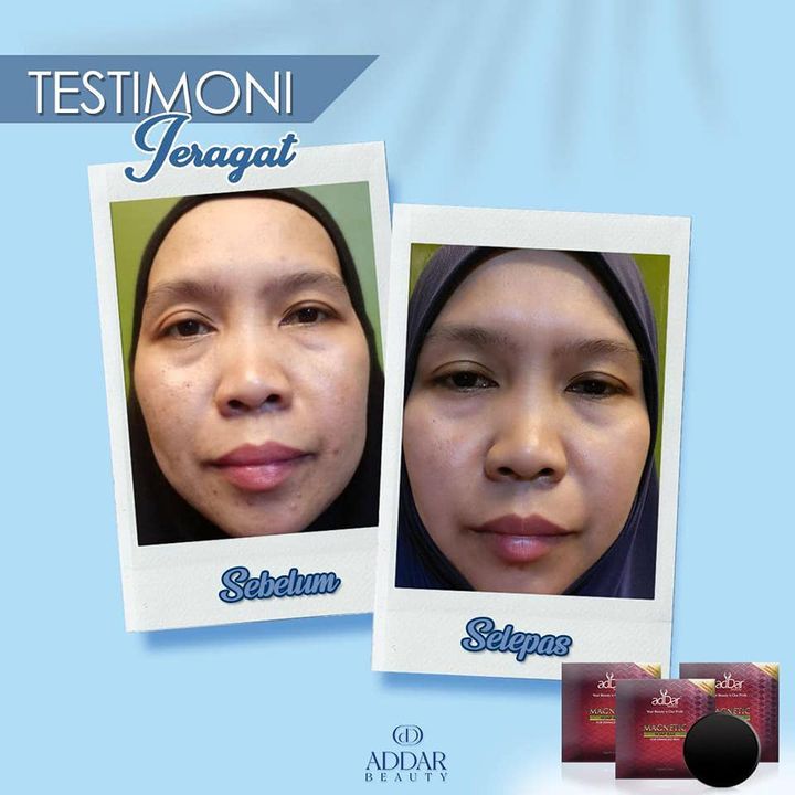 Kulit Muka Kembali Sihat Bebas Jeragat & Kusam.. 