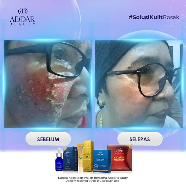 Atasi Muka Yang Breakout Hanya Dengan Detox Muka… 
