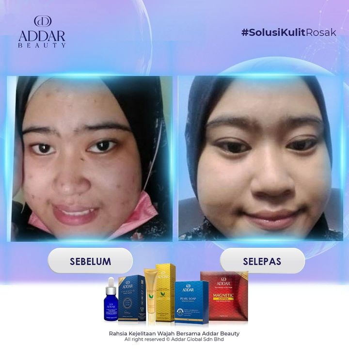 Tu Dier…muka Berparut Bekas Jerawat Siap Bonus Lagi 