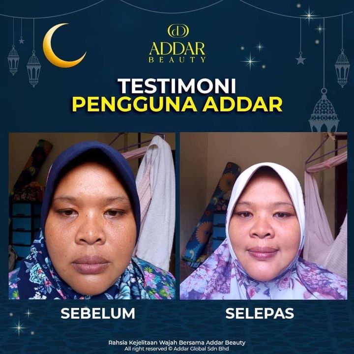 Perhatikan Jeragat Di Bawah Mata Di Atas Pipi.. 