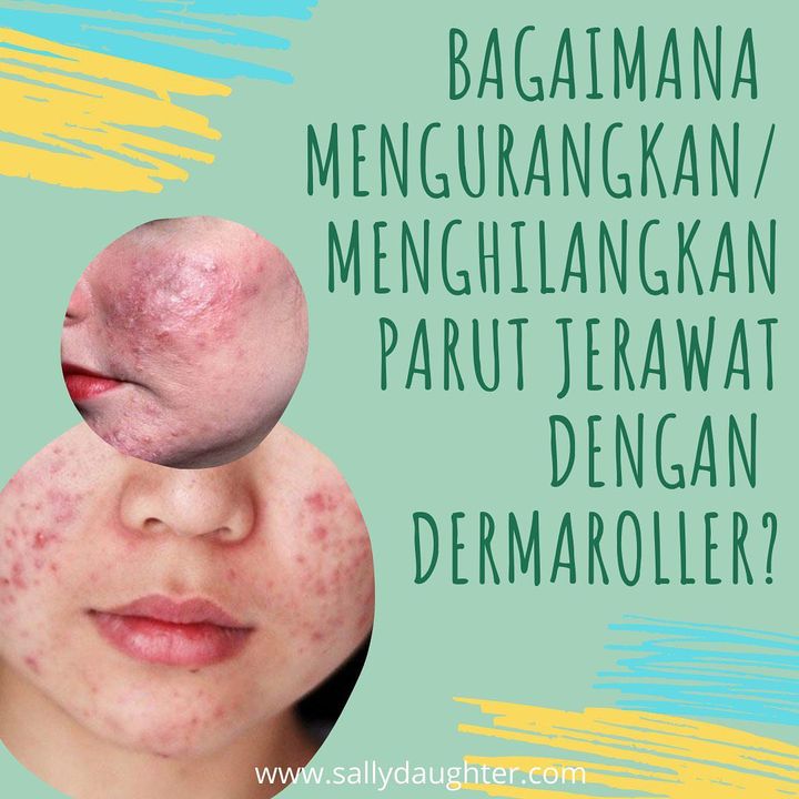 “ Sebenarnya Parut Jerawat Boleh Dirawat Dengan Pelbagai “ Sebenarnya Parut Jerawat Boleh Dirawat Dengan Pelbagai