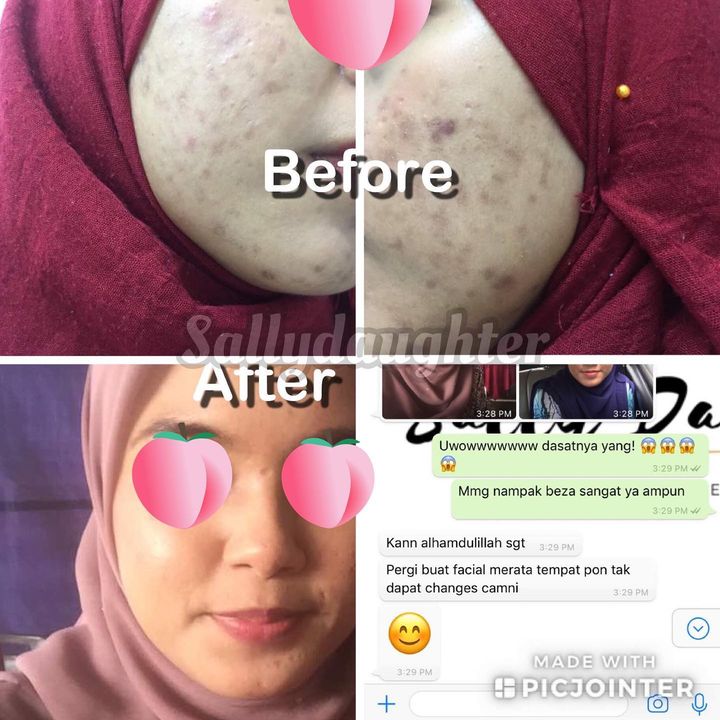 Pergi Buat Facial Merata Pon Takdapat Hasil Macam 