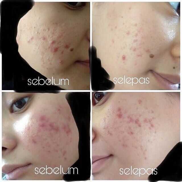 3 Tips Untuk Dapatkan Result Maksimum Selepas Treatment 