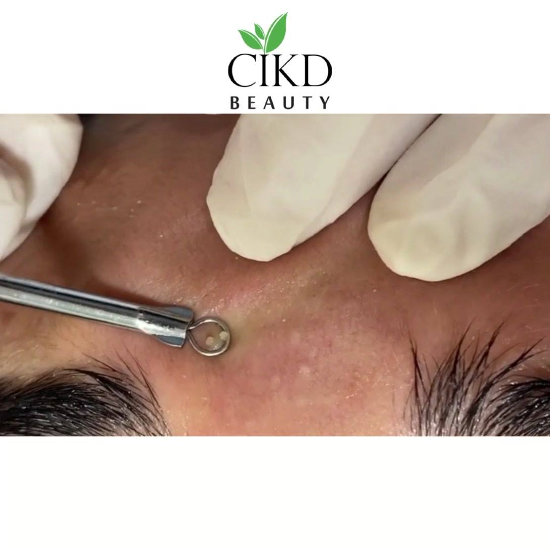 Kenapa Kita Kena Buang Blackhead Dan Whitehead Selain 