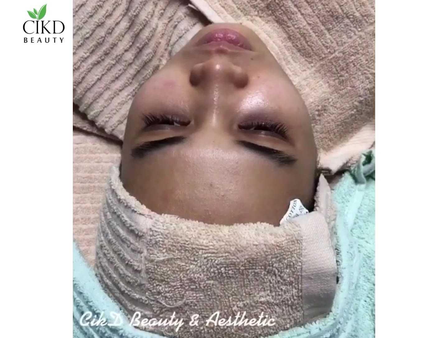 Pastikan Wajah Bebas Jerawat Dengan Rawatan Acne Eraser 