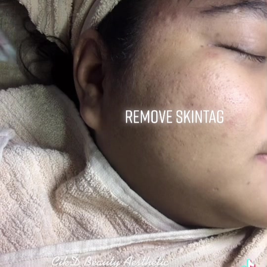 Skin Tag Kutil Ni Menganggu Betul Saya Jaga 