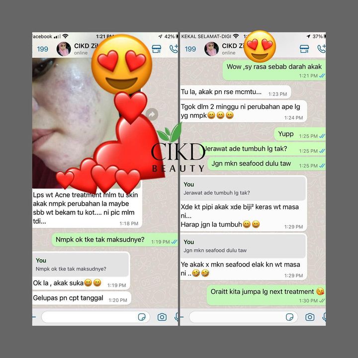 Miss Zilla Atasi Acne Masalah Kulit Berjerawat Dan 
