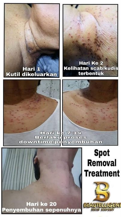 Apa Tu Kutil?  