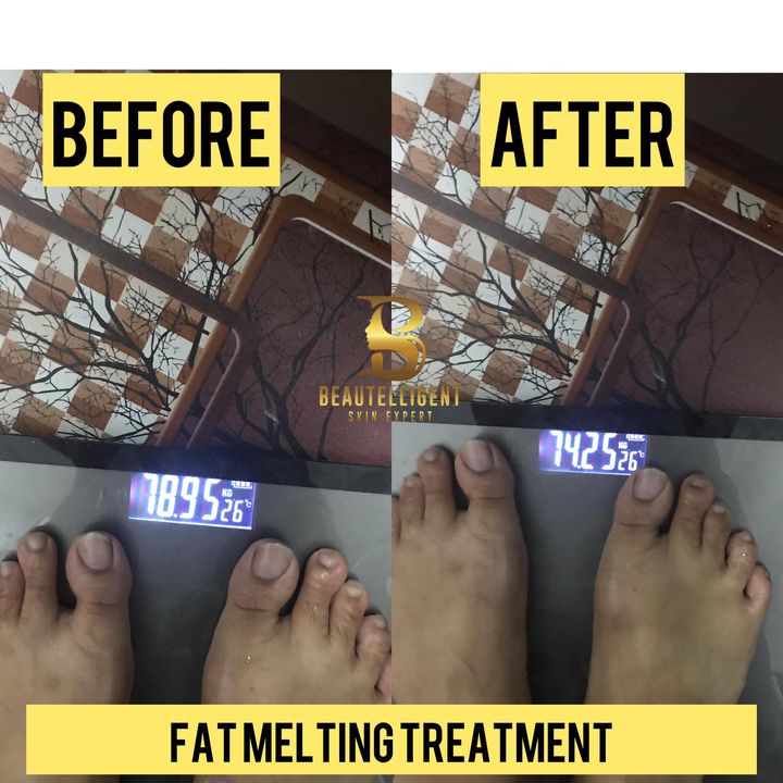 Fat Melting Treatment  