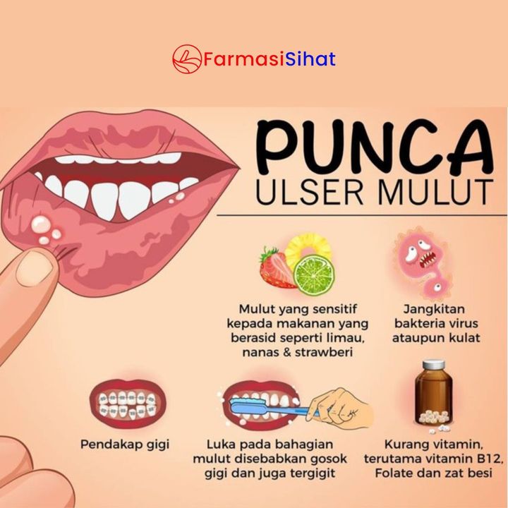 Setiap Kali Terkena Ulser Mulut Atau Mata Ikan, 