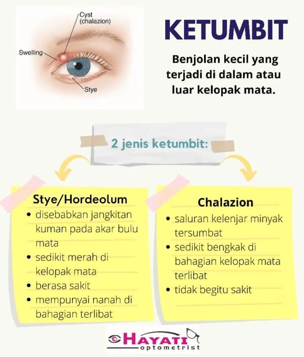 Sapa Pernah Kena Ketumbit? 